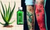 Burn Treatment Essentials: Effective Care Key Steps