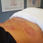 Sports Recovery Acupuncture: 6 Key Benefits You Need to Know