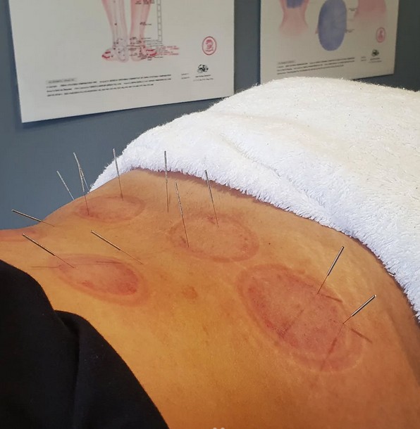 Sports Recovery Acupuncture: 6 Key Benefits You Need to Know