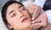 Cosmetic Acupuncture: Essential Drawbacks to Weigh Up